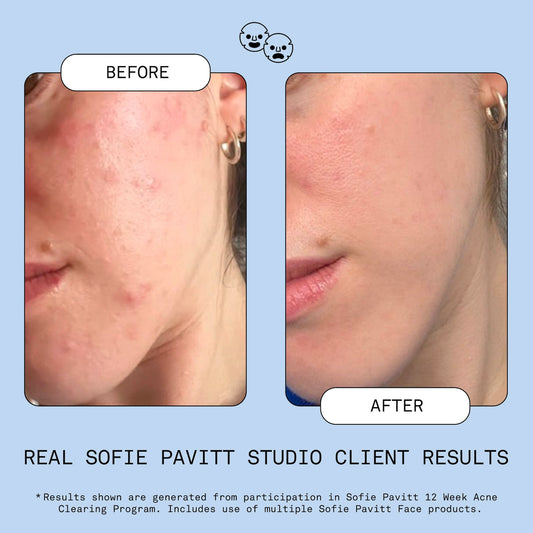 Sofie Pavitt - Fridge to Face Blemish Defense Mist