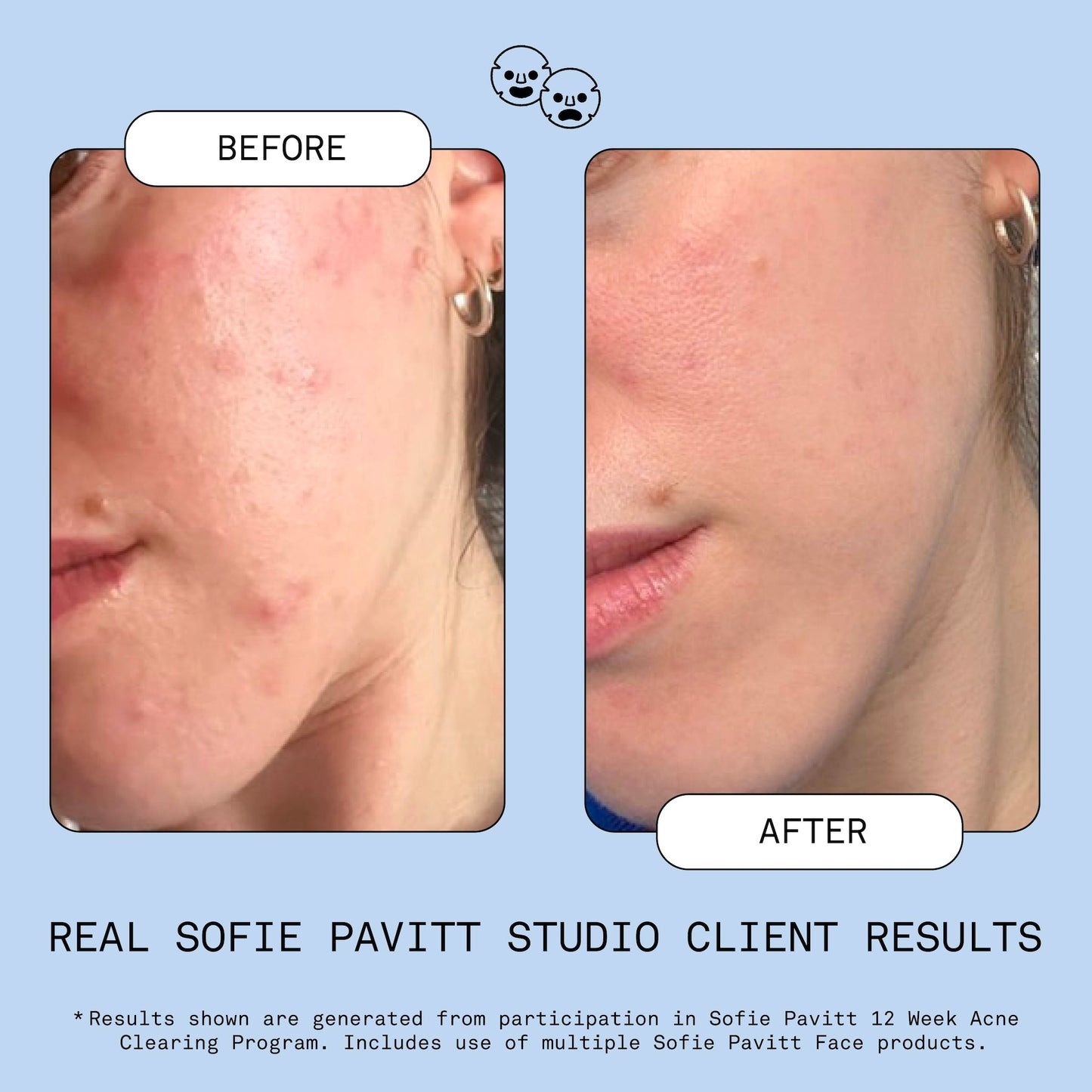 Sofie Pavitt - Fridge to Face Blemish Defense Mist